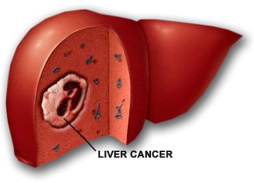 Virus viêm gan B và C là nguyên nhân gây ung thư gan hàng đầu