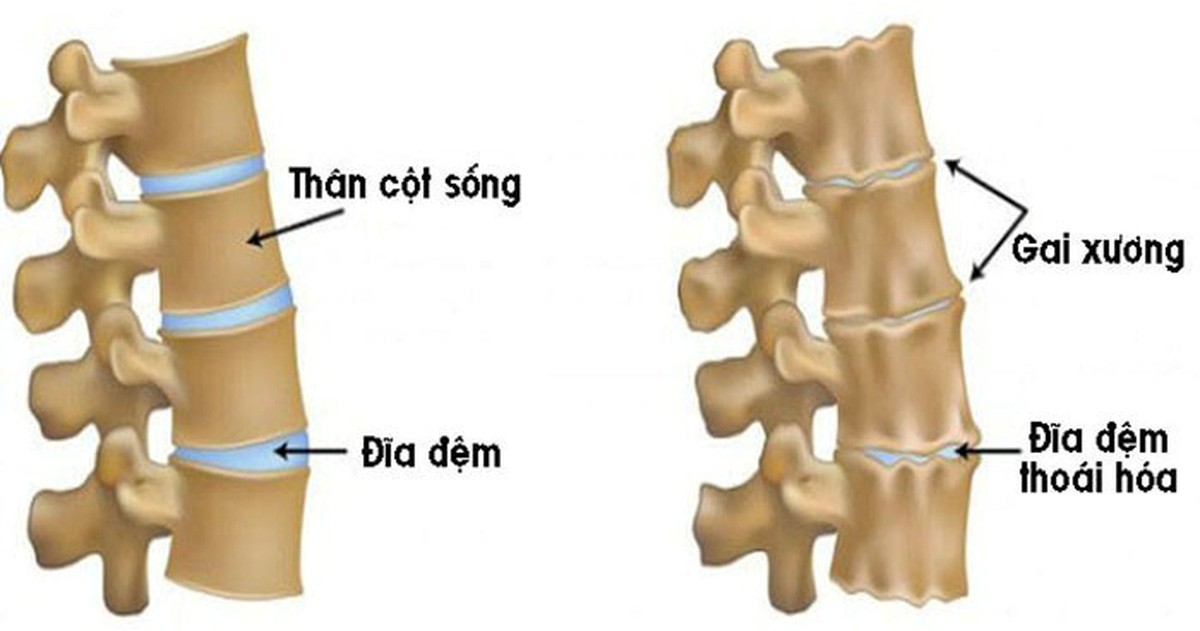 ình ảnh giữa cột sống bình thường và cột sống khi bị bệnh gai cột sống