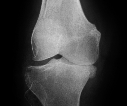 thoái hóa khớp gối